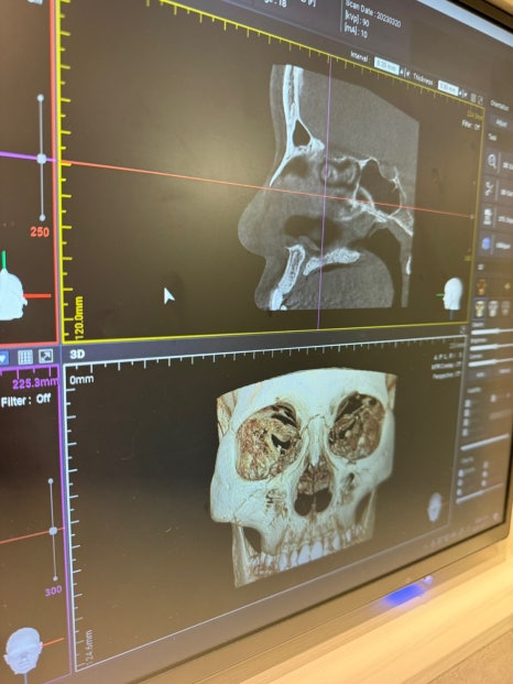 I Was Reborn with Small, Bulbous Nose Correction and Functional Nose Surgery for Deviated Septum at Kowon Plastic Surgery image 14