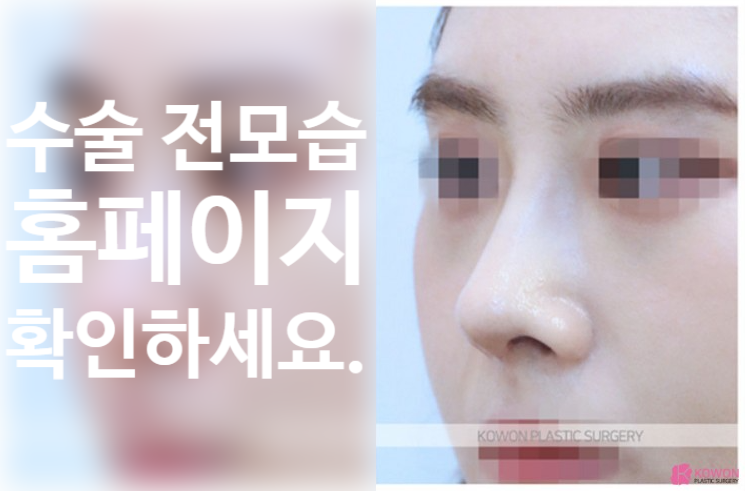 비대칭 콧대와 들린 코끝을 한 번에 잡는 휜코 수술 핵심 정리 관련 이미지 4