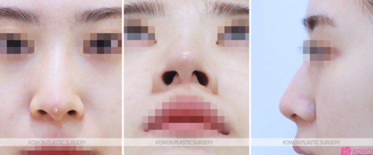 Low Nose Rhinoplasty: A Change to a More Three-Dimensional Impression, 3 Questions About Tip Cartilage Repositioning image 5
