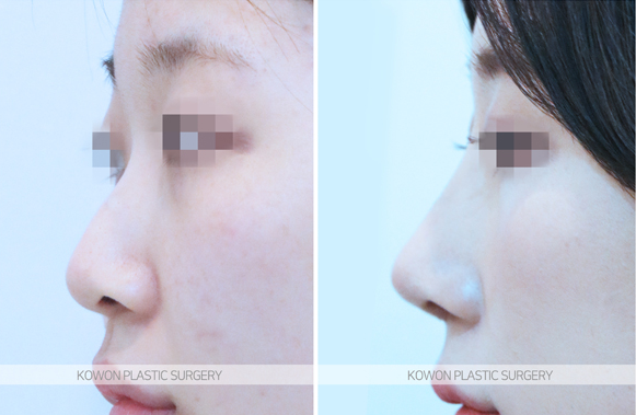 [Hump Nose Correction] Cowon Plastic Surgery Clinic: An Actual Case Showing Changes to the Drooping Tip Immediately After Implant-Free Rhinoplasty image 3