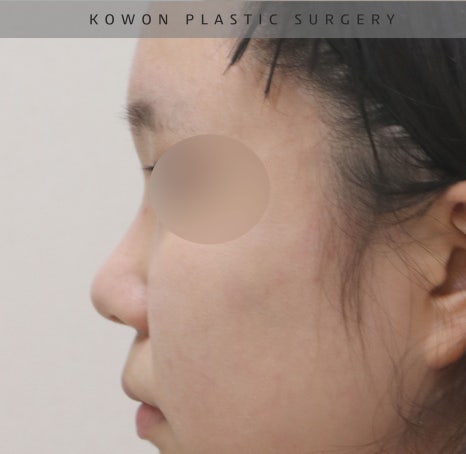 I Was Reborn with Small, Bulbous Nose Correction and Functional Nose Surgery for Deviated Septum at Kowon Plastic Surgery image 11