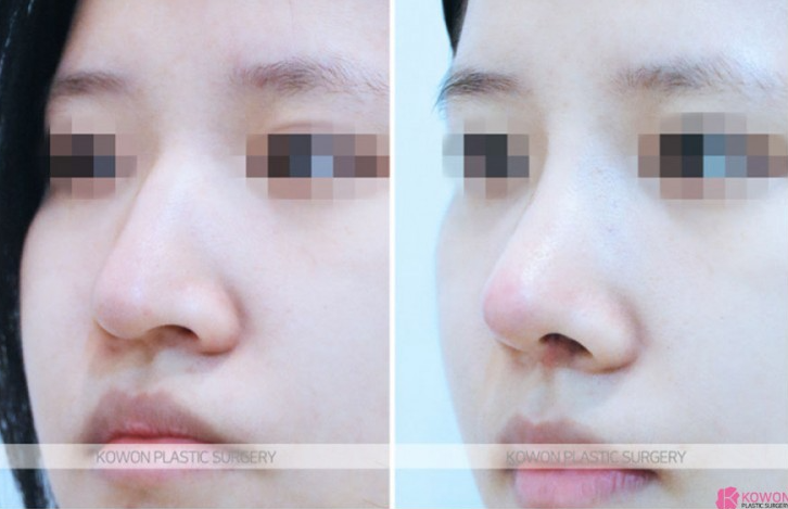 Q. Is drinking and smoking okay one month after nose surgery? A summary of nose-tip pulling symptoms and 기준 image 6