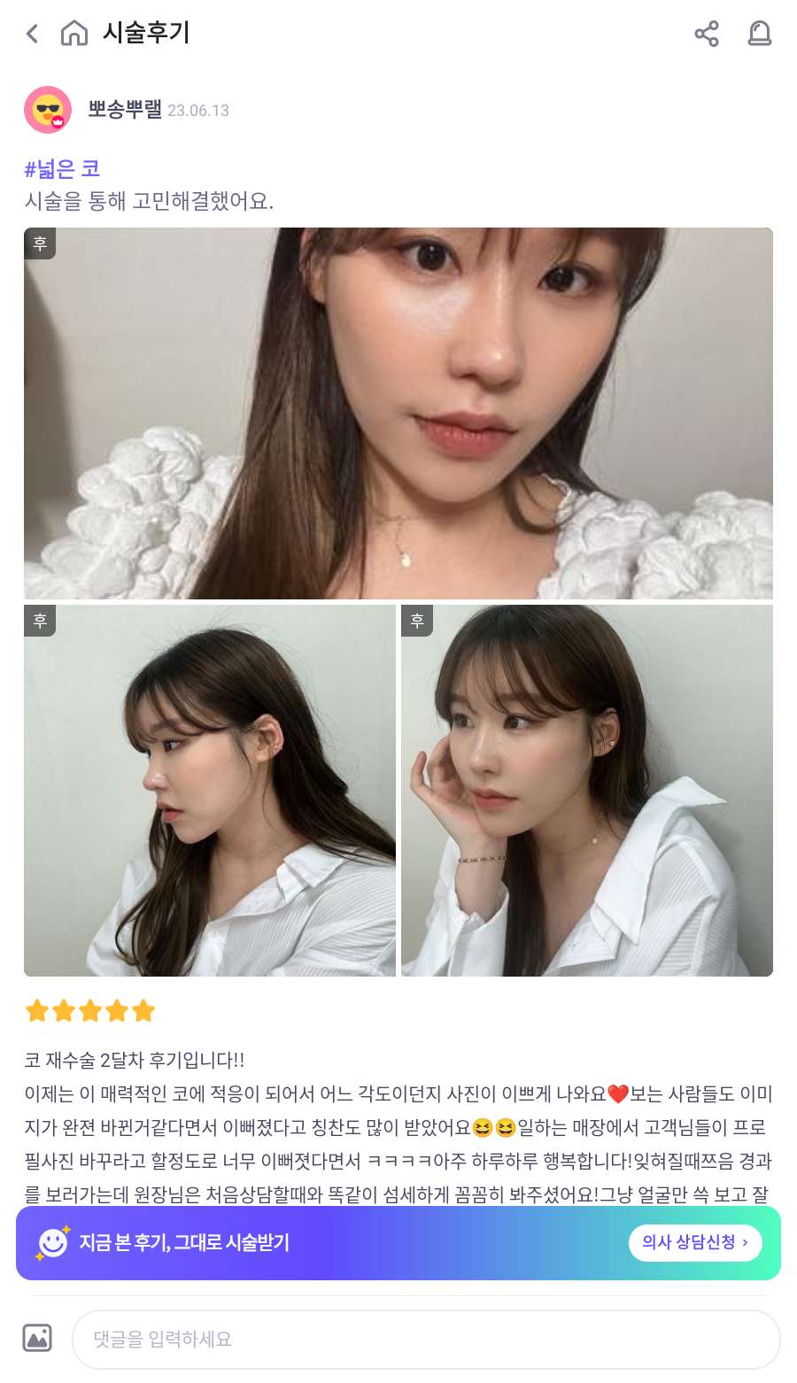 자가늑 코재수술로 비순각수술을 해서 저에게 어울리는 코를 찾았어요! 관련 이미지 4