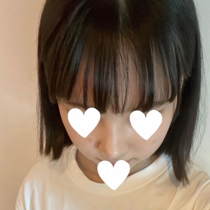 I Was Reborn with Small, Bulbous Nose Correction and Functional Nose Surgery for Deviated Septum at Kowon Plastic Surgery image 8