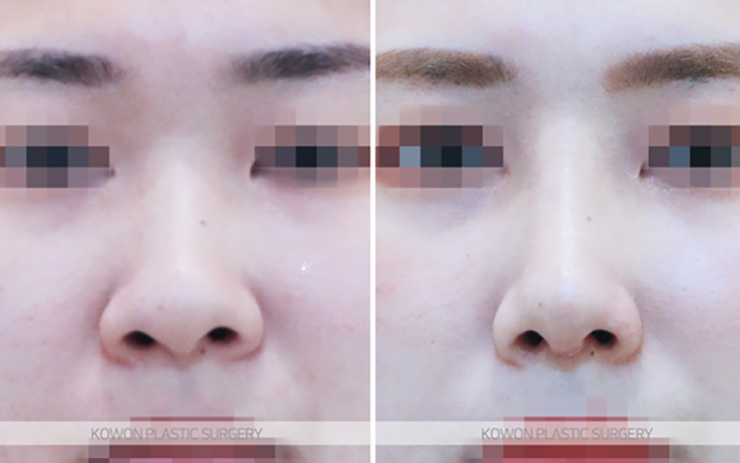 Q. I’m worried because of the difference before and after nostril reduction surgery image 9