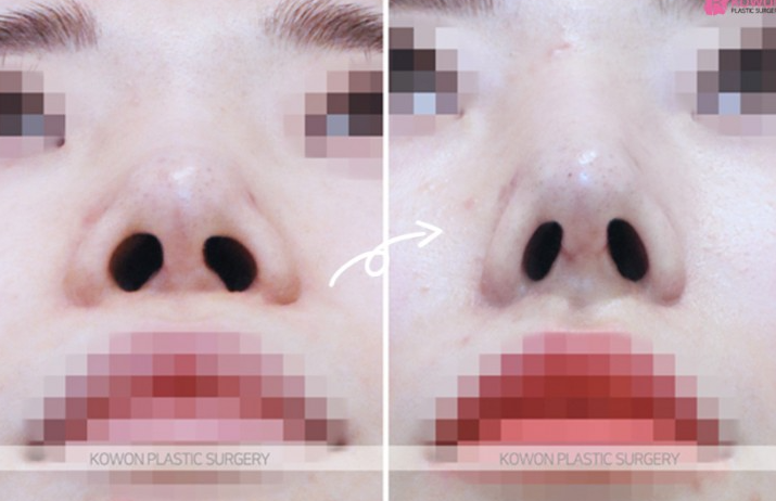 Q. I had nose surgery. Is this a complication? I’m wondering if I need revision rhinoplasty image 7