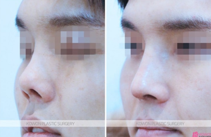 Q. How can I tell capsular contracture in the nose from scar tissue? My nose looks asymmetrical image 5