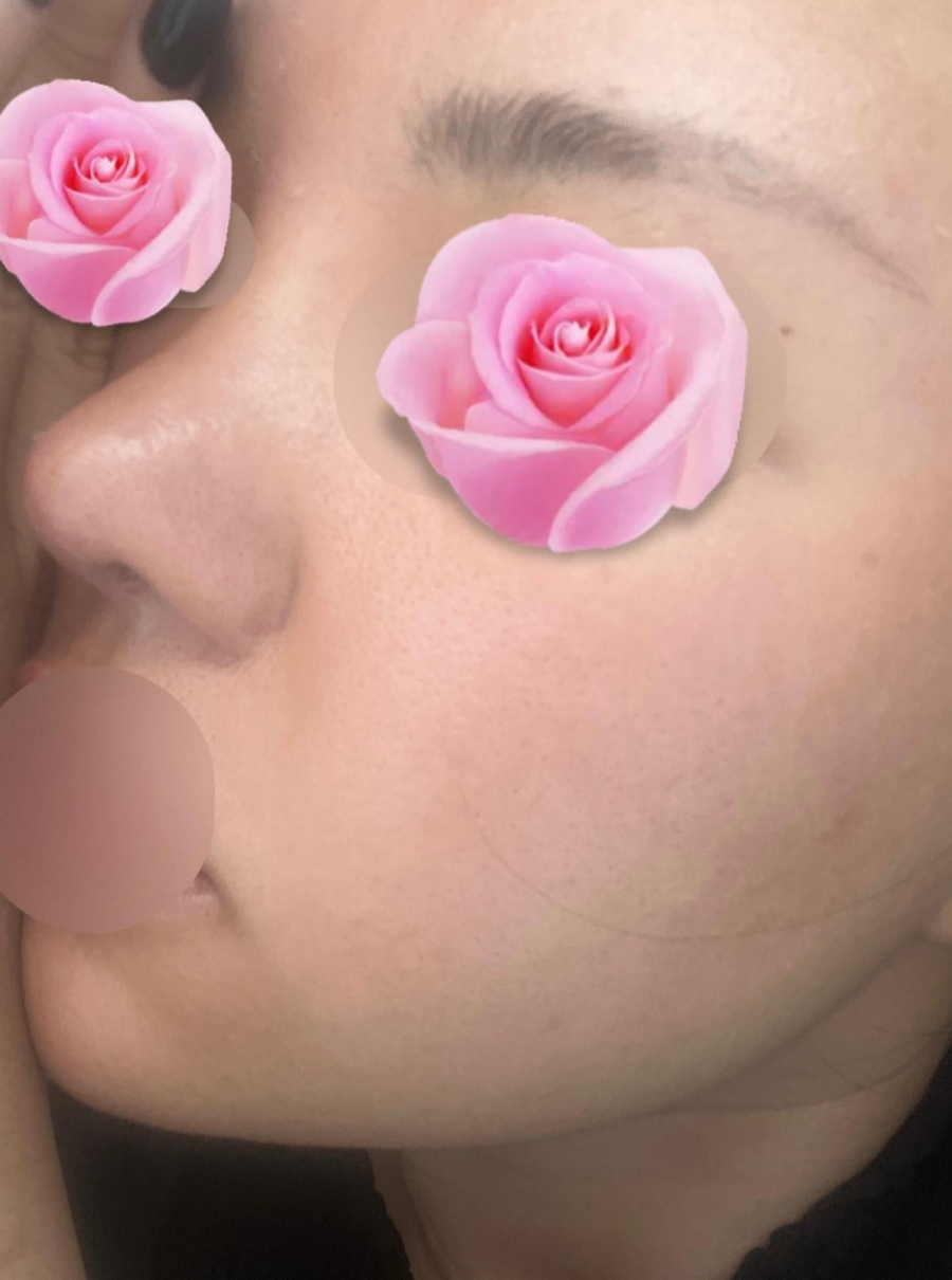This is a review of nose surgery for a bulbous nose using donated rib cartilage at Kowon Plastic Surgery! image 5