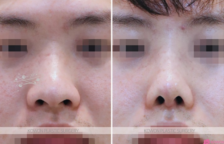 Q. Can a large nose be improved with nasal bridge osteotomy and tip surgery? (Question about male rhinoplasty before and after) image 7