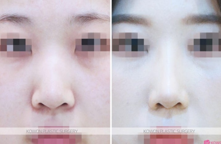 Q. 코끝재수술, 웃을 때 화살코 되는 뭉툭한 코끝은 어떻게 하나요? 관련 이미지 8