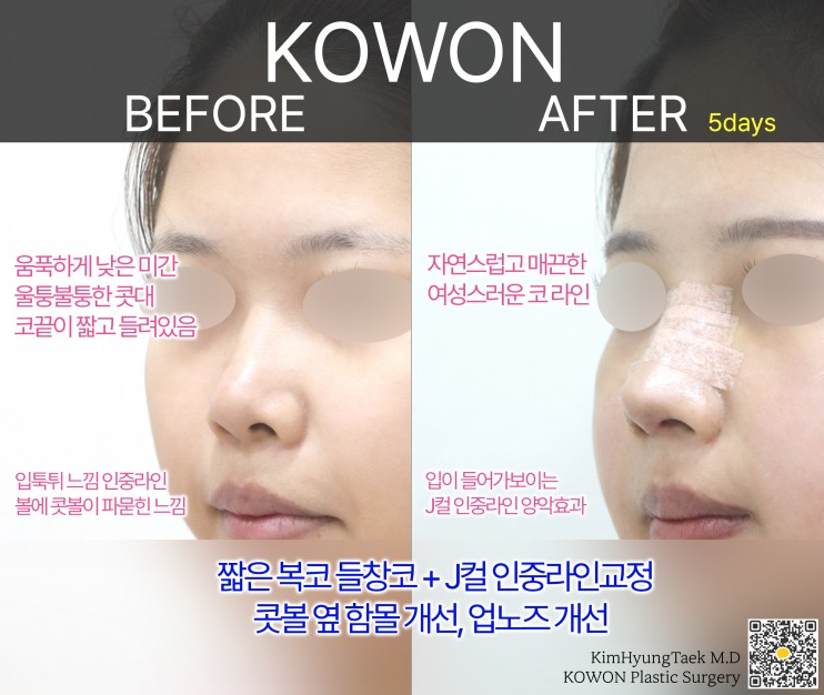 들창코성형 정면에서 콧구멍이 많이 보일 때 코끝 방향을 먼저 보는 이유 관련 이미지 5