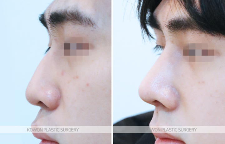 Correcting a Hump Nose and Positive Changes in the Nose Tip Line Shown in Before-and-After Male Rhinoplasty Photos image 8