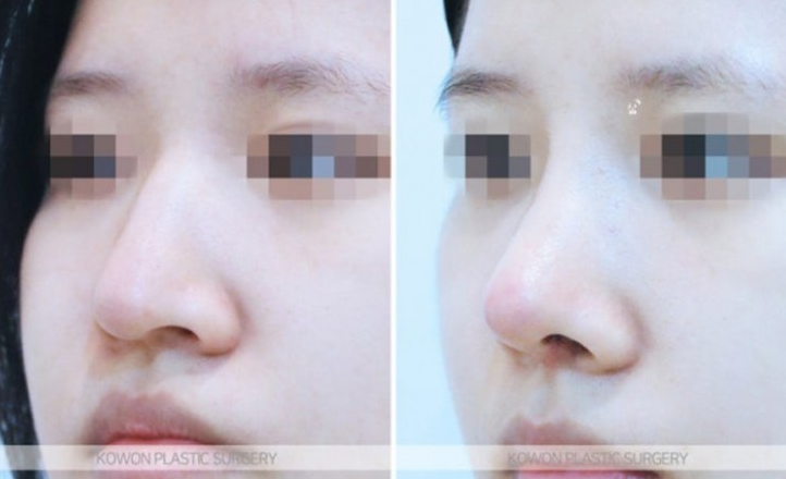 Q. Changes Before and After Hump Nose Surgery: Checking Whether a Nose Tip Dent After Rhinoplasty Is a Side Effect image 6