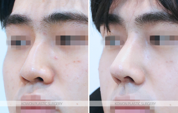 Q. 남자코성형잘하는곳에서 소개하는 남자매부리코수술의 올바른 방향 관련 이미지 5