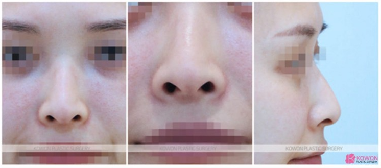 용코 교정 실제 사례로 보는 콧구멍 노출 완화와 세련된 코 라인 관련 이미지 3