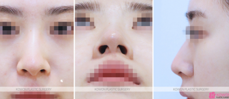 Q. Which is the right choice: nasal osteotomy or tip elevation in nose surgery? image 4
