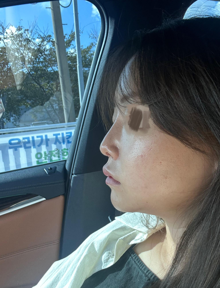 Revision Rhinoplasty Using Autologous Rib Cartilage, I Resolved My Concerns Through Surgery! image 1
