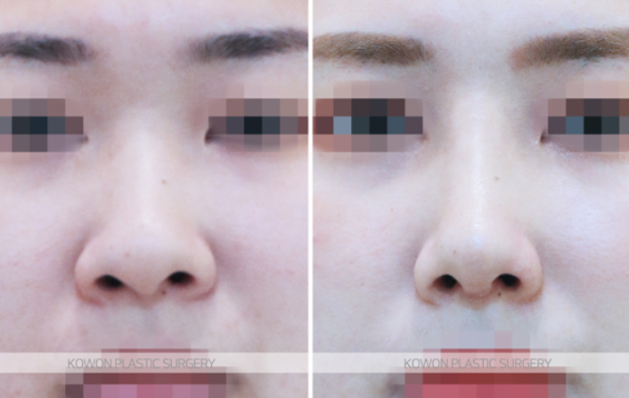 Q. Are there differences in nostril shape depending on the type of nose surgery and incision method, or not? image 6