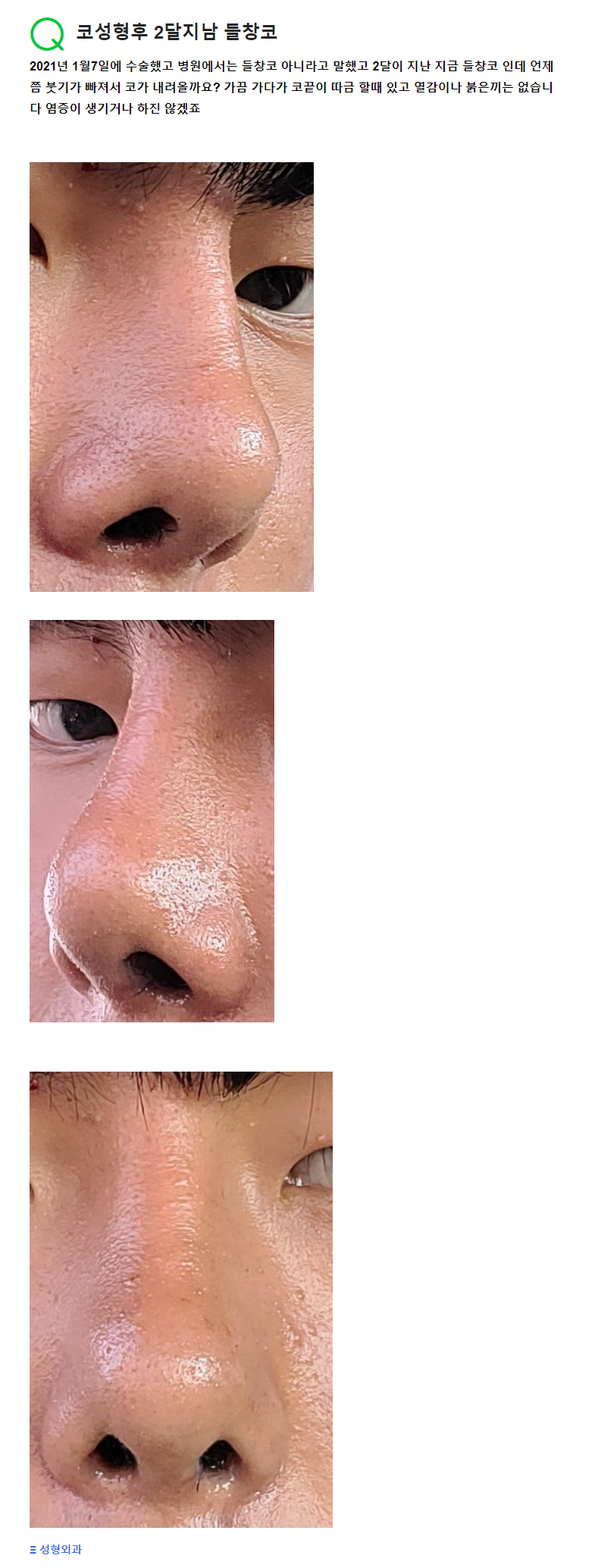 Q. 코성형 하고 2달 뒤 생긴 들창코와 부작용에 대한 문의 관련 이미지 2