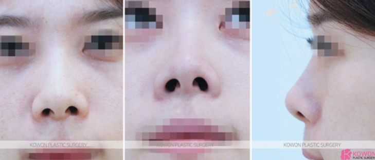 Q. After nose surgery, I can’t make a pig nose. Will removing the silicone fix it? image 4