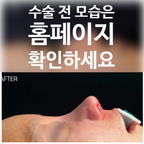 약해진 연골 구조 개선과 코끝 연골재배치로 보는 코재수술 성형외과 성공 사례 관련 이미지 2