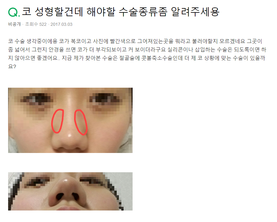 Q. I’m planning to get a nose job—please tell me the types of rhinoplasty (bulbous nose surgery) image 2