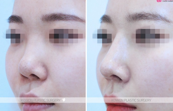 Q. I had nose surgery. Is this a complication? I’m wondering if I need revision rhinoplasty image 8