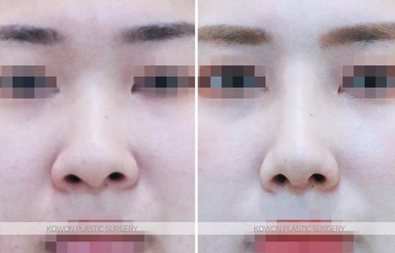 코끝연골재배치 어떤 변화가 나타날까요? 복코 라인 개선 과정 정리 관련 이미지 7