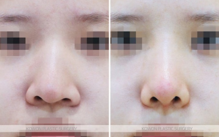 Q. Changes Before and After Hump Nose Surgery: Checking Whether a Nose Tip Dent After Rhinoplasty Is a Side Effect image 5