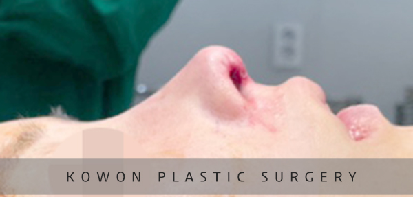 Revision Rhinoplasty Using Autologous Rib Cartilage, I Resolved My Concerns Through Surgery! image 9