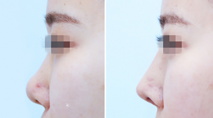 Q. Why Do the Nostrils Look Uneven After Revision Nose Surgery with Ear Cartilage? image 9