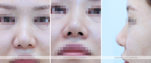 Looking at the Change Process Before and After Bulbous Nose Surgery and the Flow of Nasal Tip Structural Improvement image 5