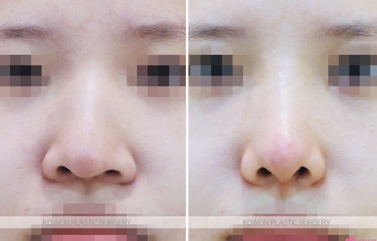 Q. 매부리코 수술 부작용이 걱정될 때 확인할 점 알아보기 관련 이미지 6