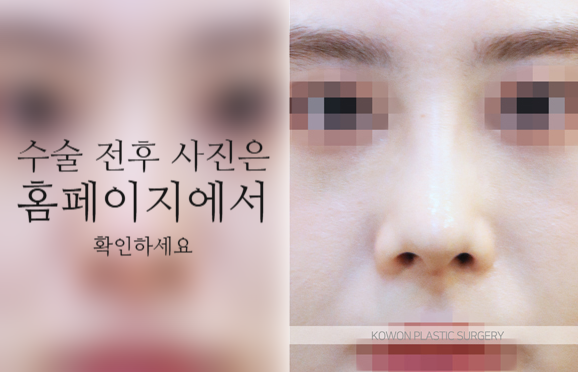 코끝연골재배치 자연스러운 자려한 코를 만드는 3가지 포인트 관련 이미지 8