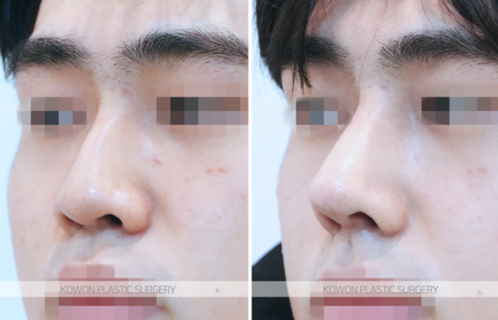 Correcting a Hump Nose and Positive Changes in the Nose Tip Line Shown in Before-and-After Male Rhinoplasty Photos image 6