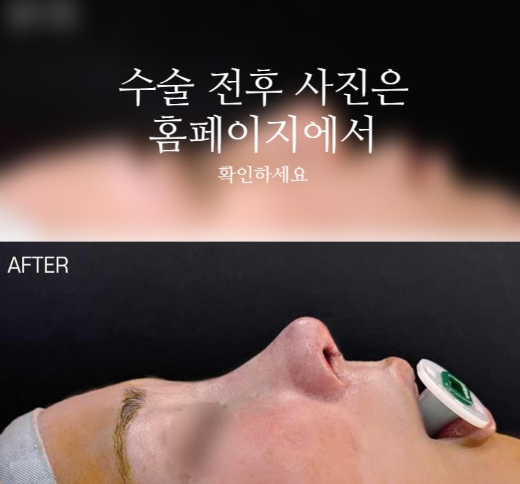 여자매부리코, 복코까지 함께 고려해야 하는 3가지 이유 관련 이미지 2