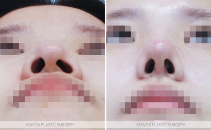 Q. Changes Before and After Hump Nose Surgery: Checking Whether a Nose Tip Dent After Rhinoplasty Is a Side Effect image 8