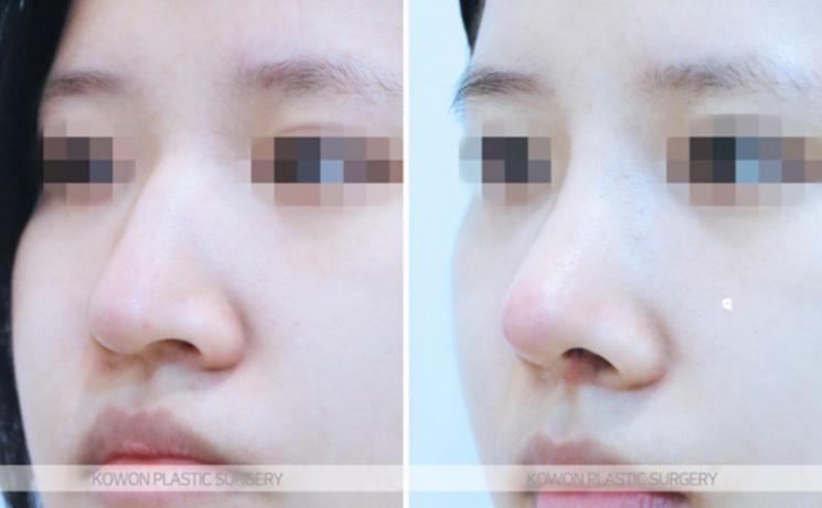 Q. I’m worried about side effects from nose surgery. Please tell me how to reduce swelling after nose surgery. image 7