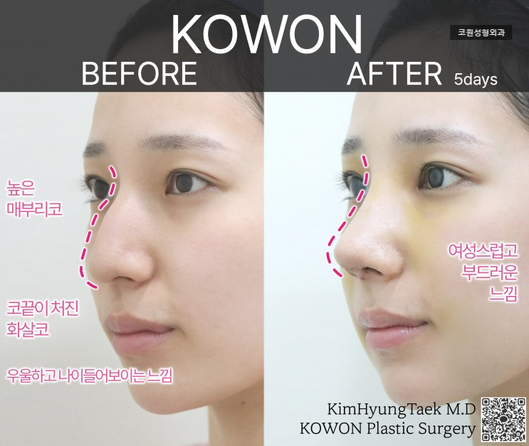 For Female Hump Nose Surgery, Start with the Cheek Line Rather Than Simply Smoothing the Hump image 3