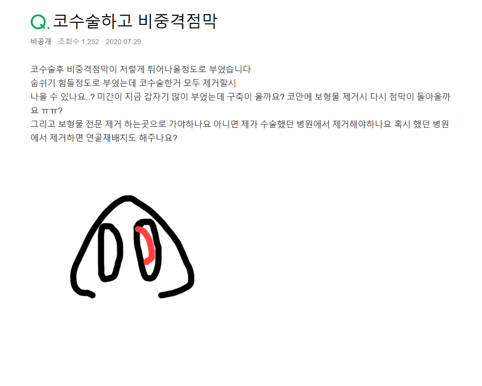 Q. 코수술 후 코안 점막 부음(코수술부작용)일까요? 관련 이미지 2