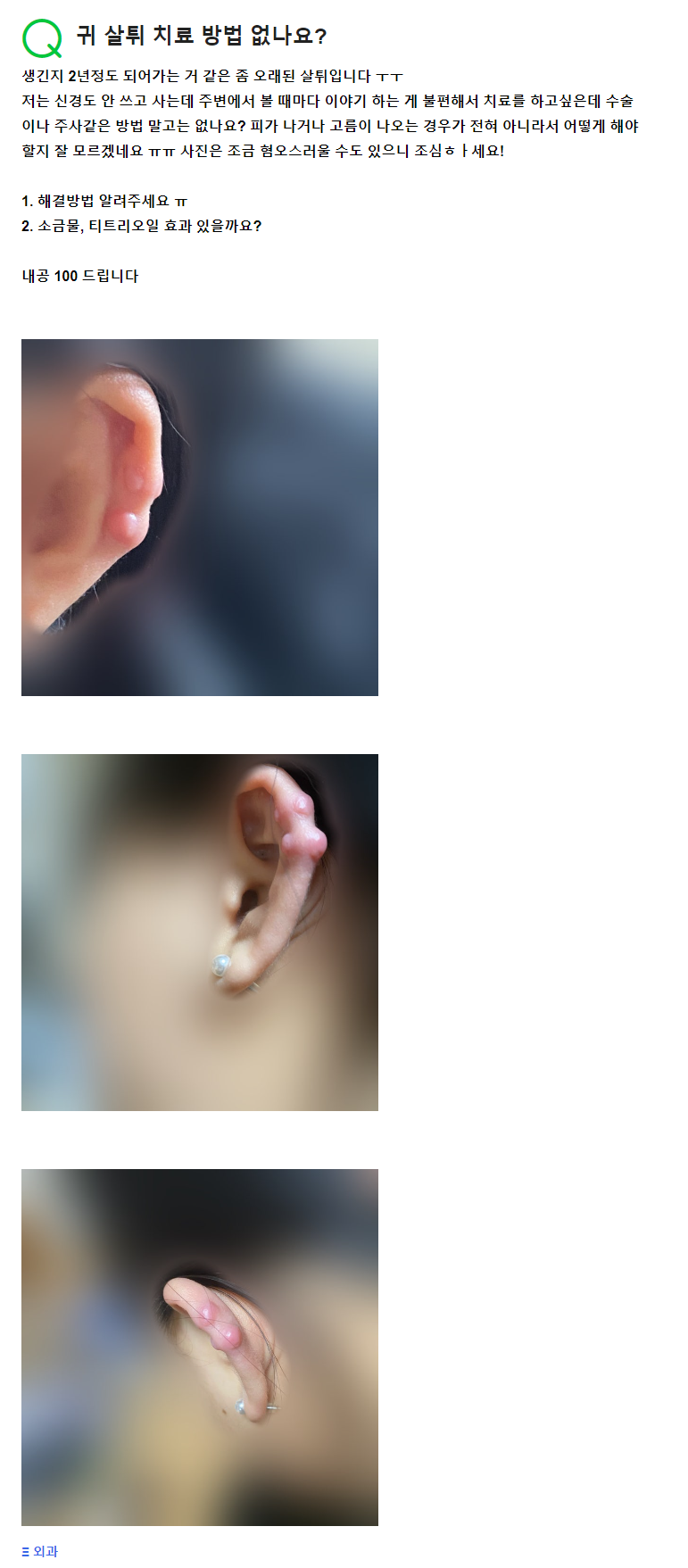 Q. 귀 뚫은 곳 몽우리, 귀켈로이드 때문에 고민이에요. 관련 이미지 2