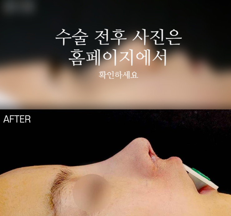 코끝연골재배치 자연스러운 자려한 코를 만드는 3가지 포인트 관련 이미지 2
