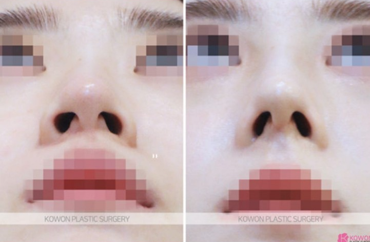Q. Is non-open nose surgery possible? A complete guide to concerns about general anesthesia image 8