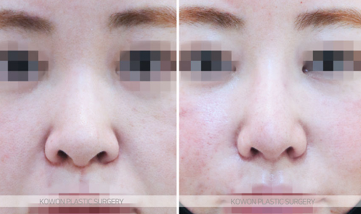 Q. Concerned about revision surgery for a long and wide nose: What is the key to natural-looking nose surgery results? image 7
