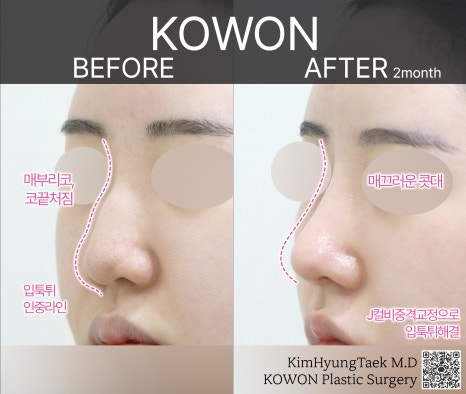 울퉁불퉁해 신경 쓰이던 코를 코원성형외과에서 낮은코와 매부리코교정으로 매끄럽게 만들었어요! 관련 이미지 23