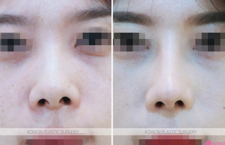 Q. After nose surgery, I can’t make a pig nose. Will removing the silicone fix it? image 8