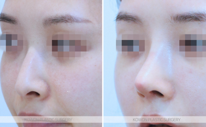 Q. I’m worried that a 4 mm silicone implant for a nose bridge augmentation will look obvious image 6
