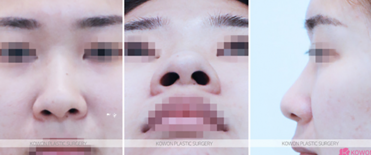 Q. I’m worried because of the difference before and after nostril reduction surgery image 4