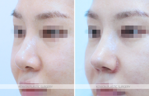 Looking at the Change Process Before and After Bulbous Nose Surgery and the Flow of Nasal Tip Structural Improvement image 4