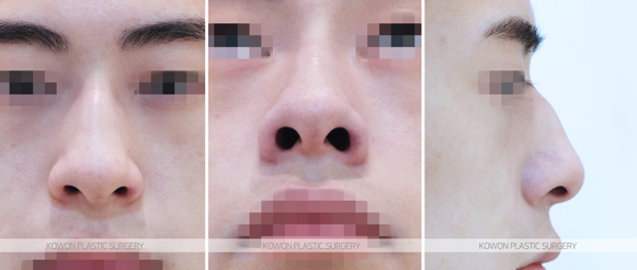 How Much Does a Man’s Hump Nose Surgery Change Your Appearance? Before-and-After Changes and Recovery Time Summary image 4